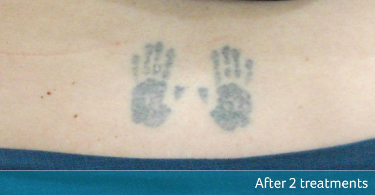 laser tattoo removal of small tattoo at skinoza clinic after two treatments result
