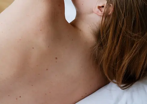female back with multiple warts and birth marks
