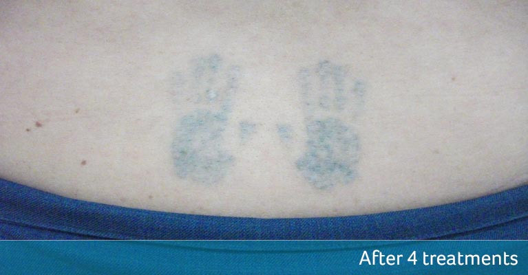 laser tattoo removal of small tattoo at skinoza clinic after four treatments result