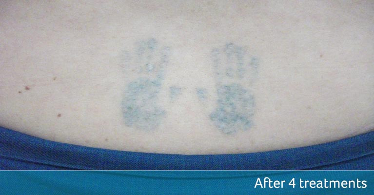 laser-tattoo-removal-4-treatments