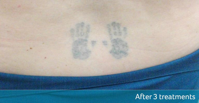 laser tattoo removal of small tattoo at skinoza clinic after three treatments result