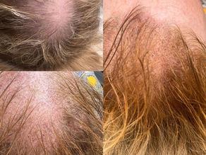 scalp micro pigmentation