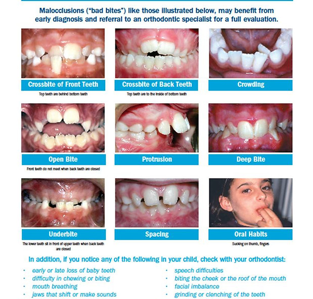 Types of "bad bites" in human mouths