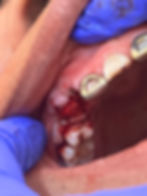 Bone Grafting photo 23