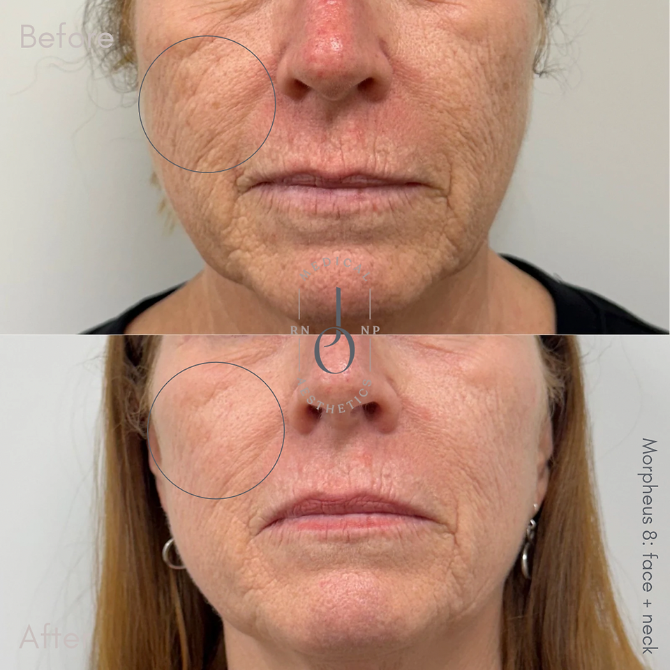 Morpheus8 before and after showing improvement in the appearance of deep facial wrinkles.