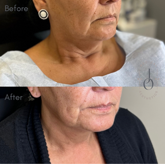 Morpheus8 neck tightening results in Winnipeg