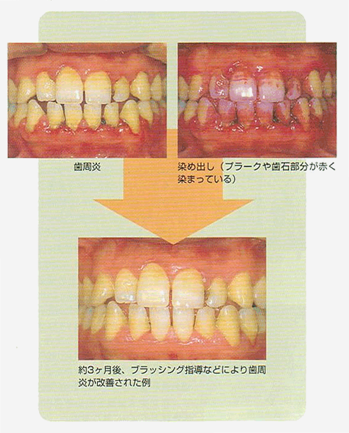 歯周病の改善