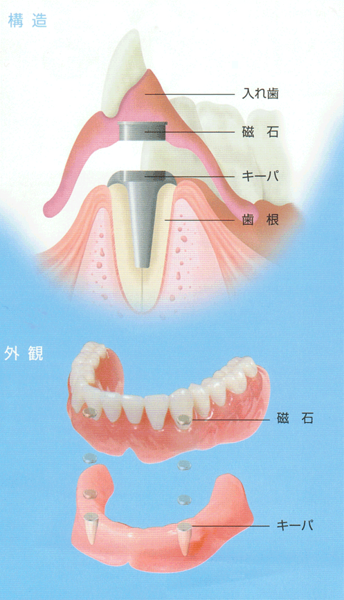 磁石式入れ歯