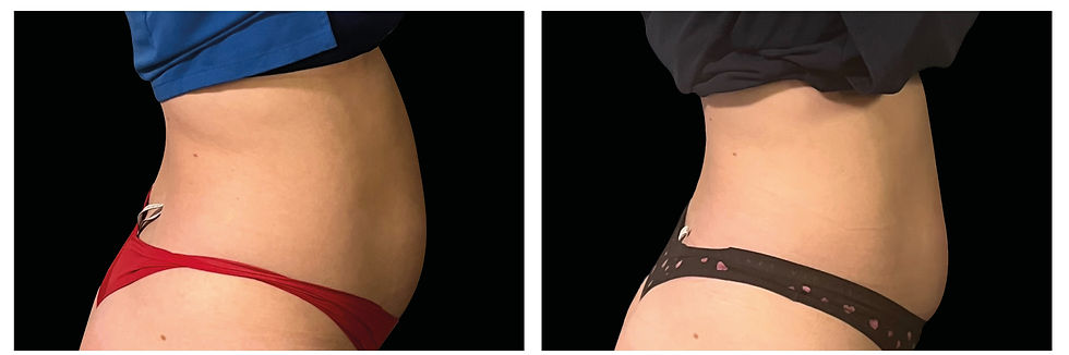Emsculpt_Neo-Weight-Loss_PIC_Ba-card-female-abdomen-012_ENUS101_edited