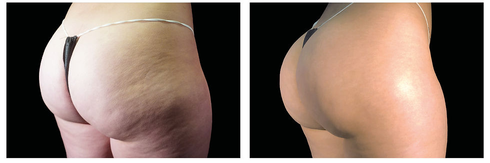 Emsculpt_Neo-Emtone_PIC_Ba-card-female-buttock-008_ENUS100_edited
