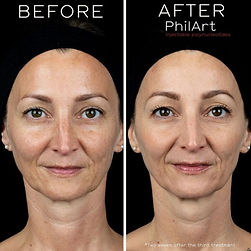 Polynucleotides near Gillingham ZOLU Medical Aesthetics