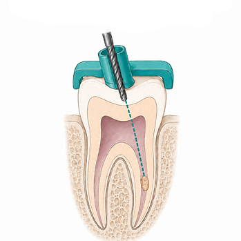 Calcified Canal Guides (2).png