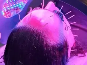 Simple Guideline to Facial Rejuvenation Acupuncture