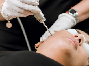 Fotona: el láser que trata desde arrugas hasta caída de cabello