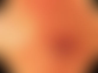 DMLA
