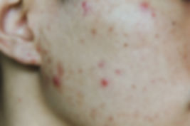 Acne and pimple on the skin.jpeg