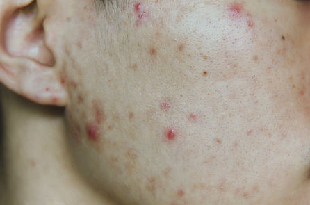 Acne and pimple on the skin.jpeg