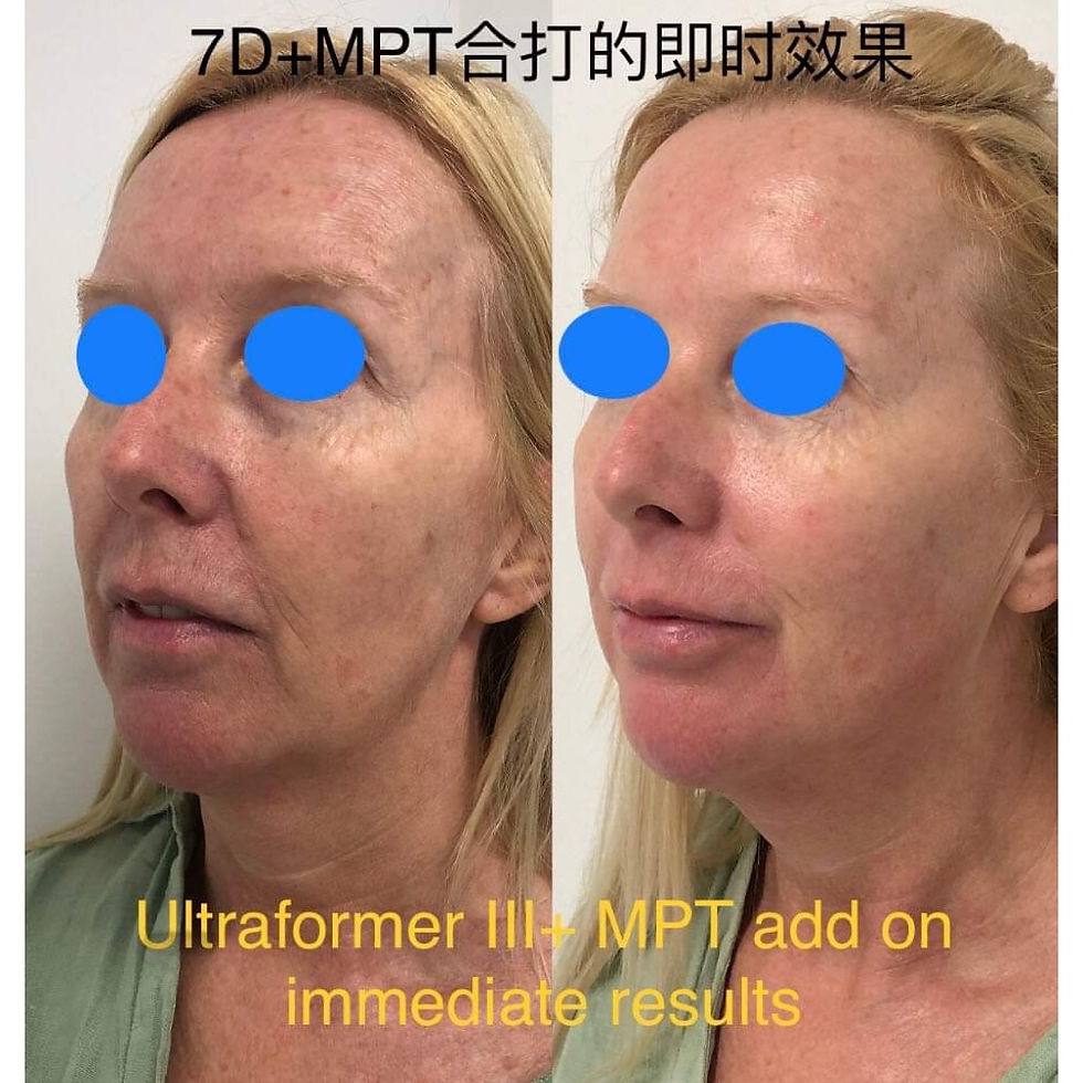 Ultraformer III+ MPT add on immediate results @ Bloom Skin and Massage
