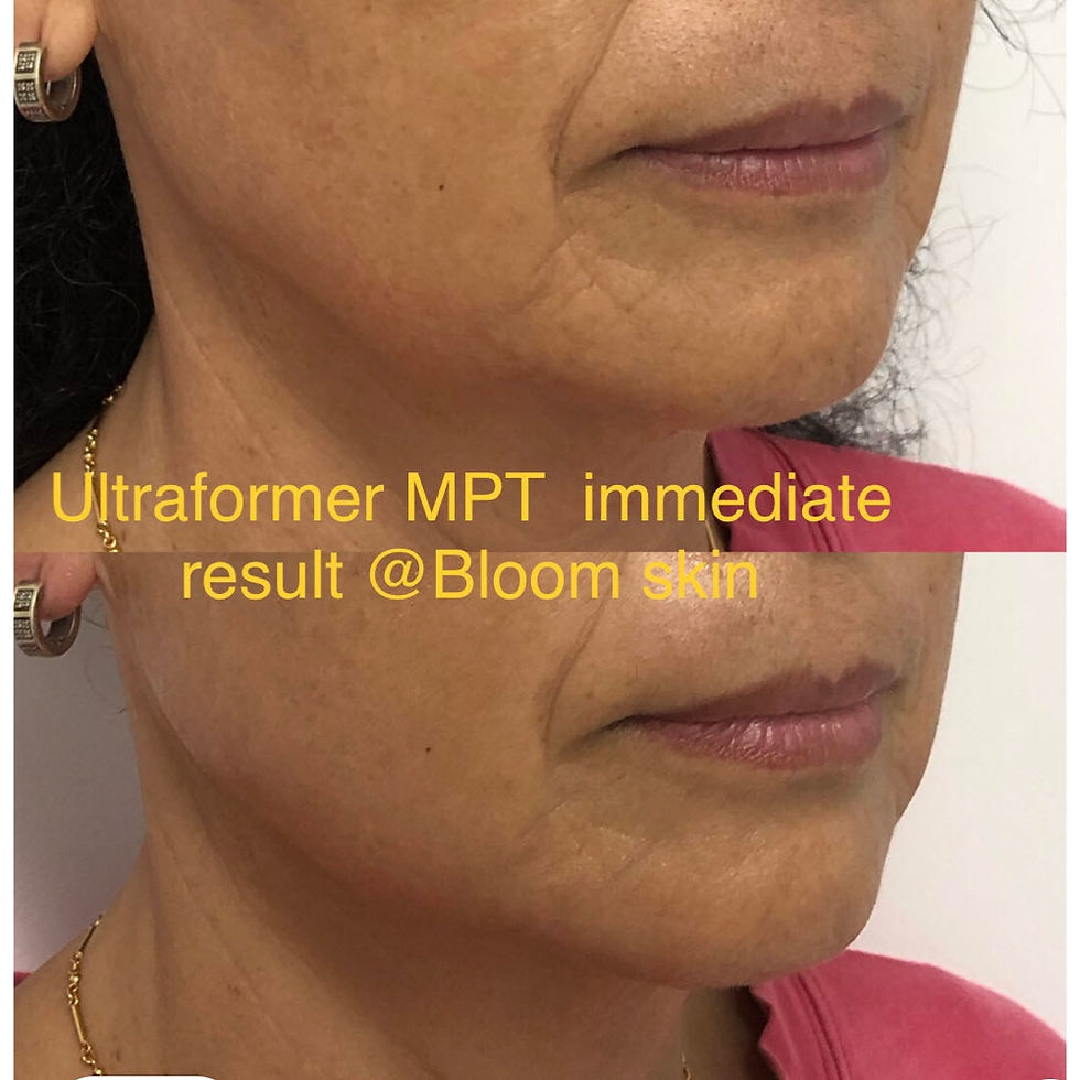 Ultraformer MPT immediate results @ Bloom Skin & Massage