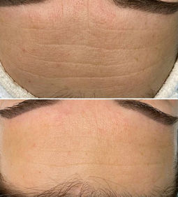 Forehead before and after wrinkle treatment