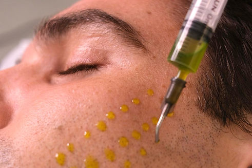 Biorepeel being applied on man skin