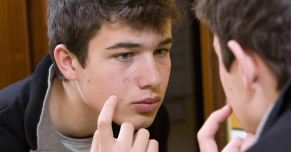 Why Your Acne Isn't Going Away