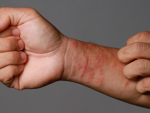 What Is Eczema?