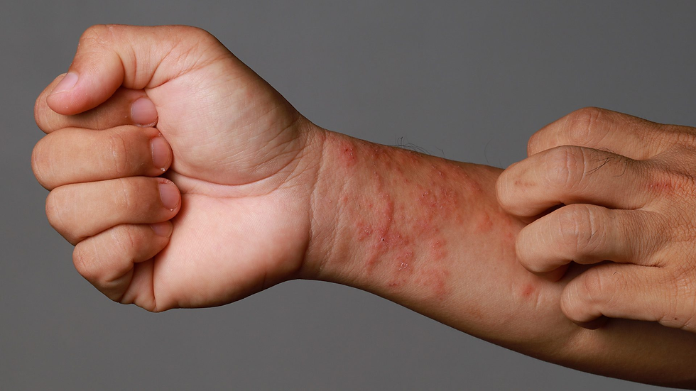 What Is Eczema?