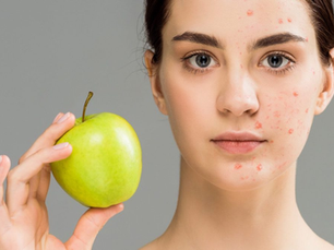 The Role of Diet in Acne