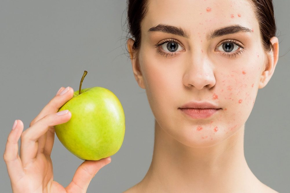 The Role of Diet in Acne