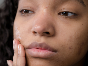 The Link Between Mental Health and Acne in Teenagers
