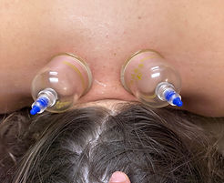 Two cups on upper back