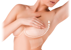 breast-lift.png