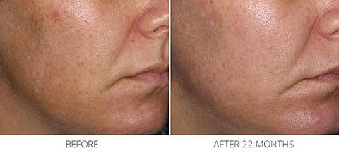 melasma