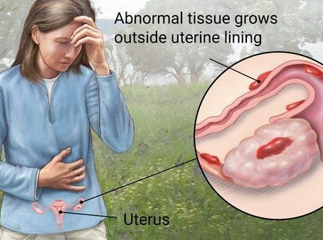 ENDOMETROSIS – ITS VIEW IN AYURVEDA