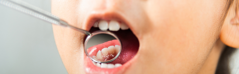 preventing and treating cavities in kids in South Jersey