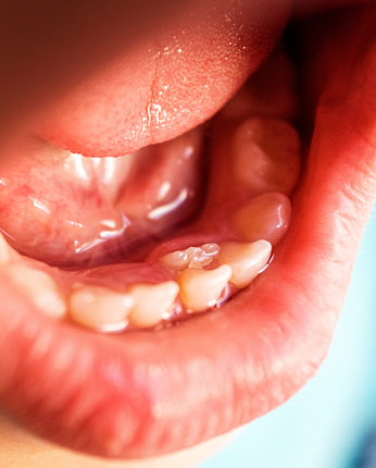 guiding healthy tooth eruption in kids across South Jersey.png