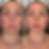 Lip filler before and after at Replenish