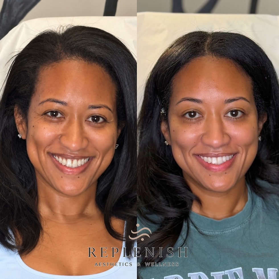 replenish-tox-filler-before-after.jpg