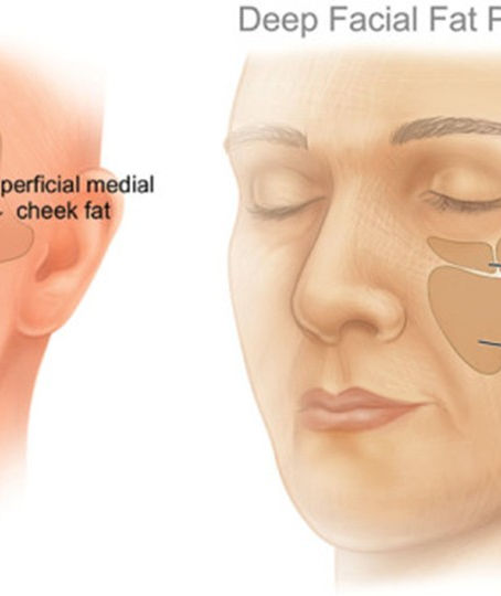 GLP-1 Weight Loss Face Treatment in Upminster, Essex | Sculptra & Restylane for Facial Volume Loss