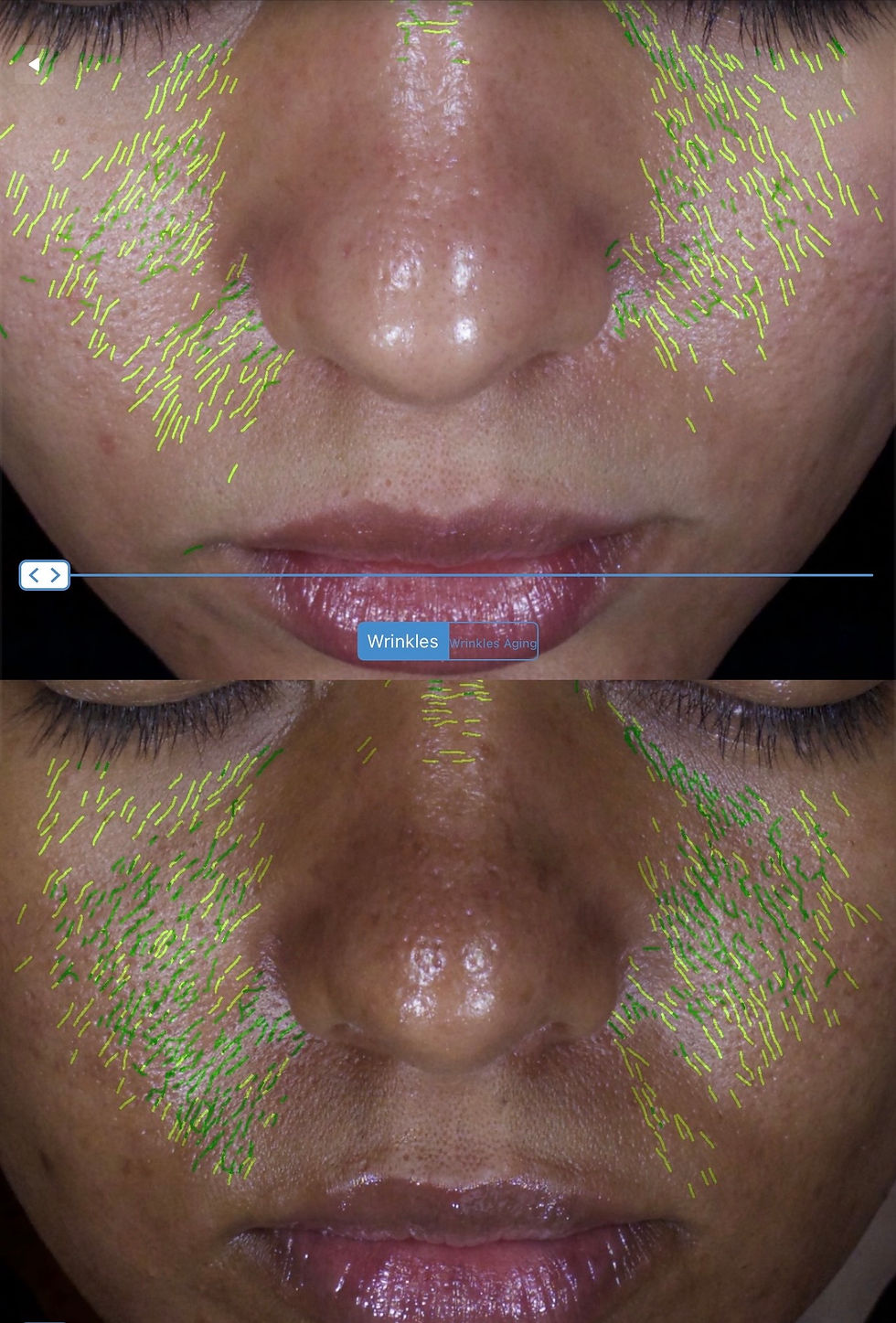 Increased skin wrinkles caused due to sun exposure with little SPF used, this in turn has reduced collagen and elastin