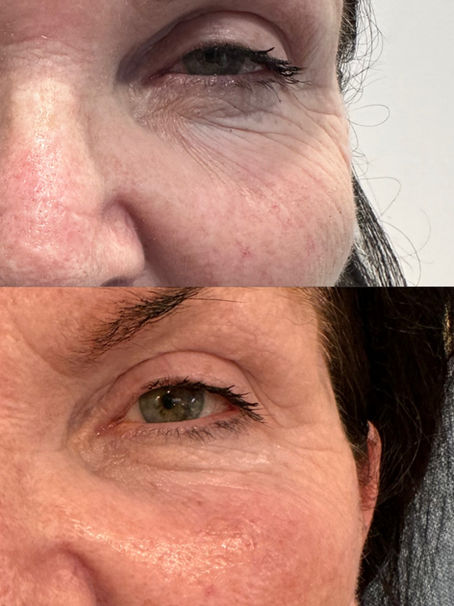 Polynucleotides: The Regenerative Secret for Tired Eyes