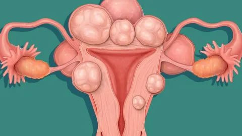 What is Myoma ? Symptoms , Diagnosed , Causes , Treatments
