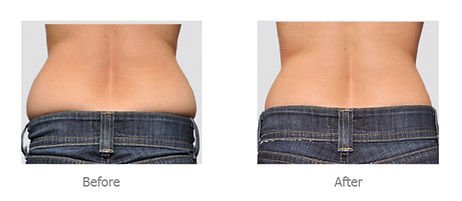 cavitation-before-after_edited.jpg
