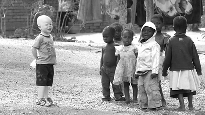 Albinism_edited.png