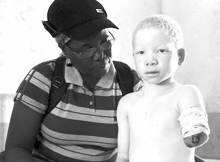 person-with-albinism-2_edited.jpg