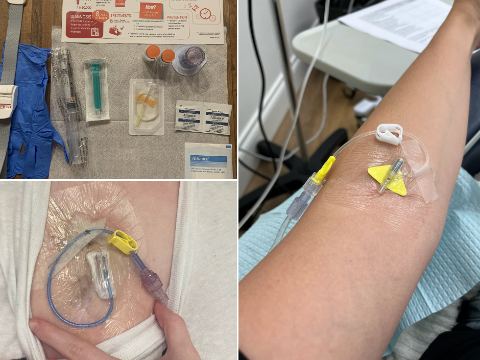 Over 500 IV treatments at home before the port. This is what managing HAE looks like.