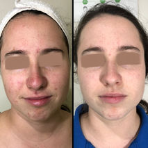 לפני ואחרי טיפול אצל יוליה טפליאקוב