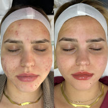 לפני ואחרי טיפול אצל יוליה טפליאקוב