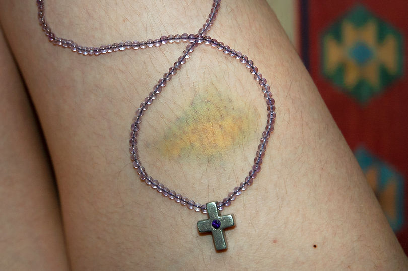 bruise.jpg